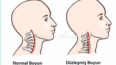 Boyun Düzleşmesi Yaşayanların Yorumları