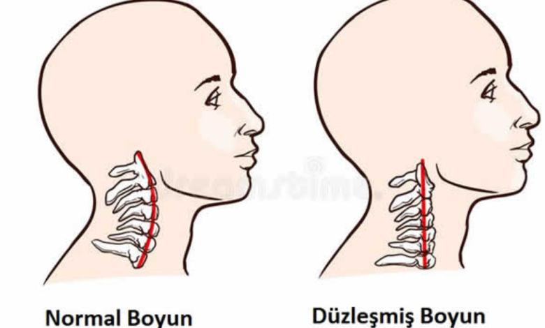 Boyun Düzleşmesi Yaşayanların Yorumları